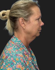 Patient 1, Before number 3