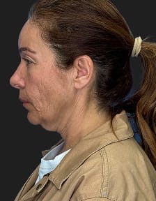 plastic sugery patient photo