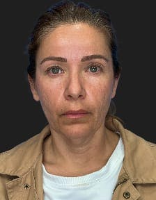 plastic sugery patient photo