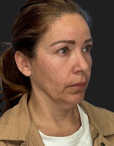 plastic sugery patient photo