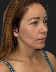 plastic sugery patient photo