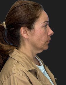 plastic sugery patient photo