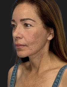 plastic sugery patient photo