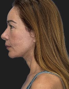 plastic sugery patient photo