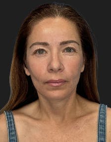 plastic sugery patient photo