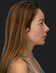 plastic sugery patient photo