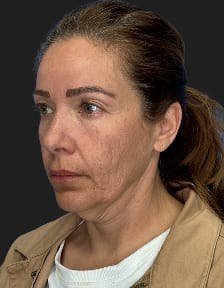 plastic sugery patient photo