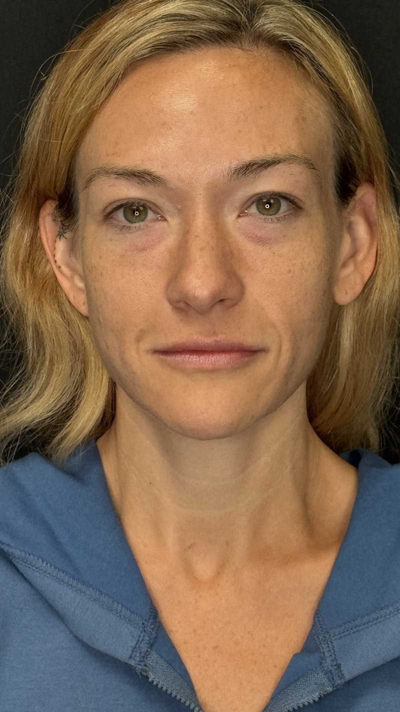 Cheek Implant Before & After Gallery - Patient 236191 - Image 1
