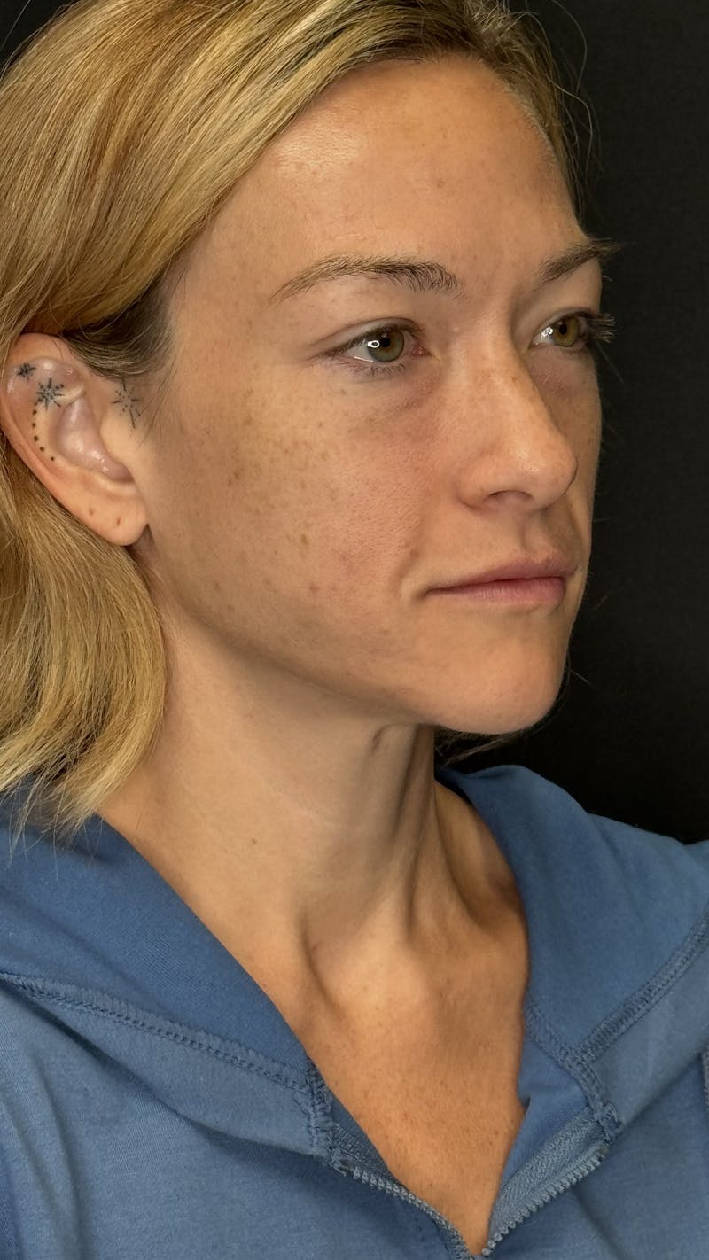 Cheek Implant Before & After Gallery - Patient 236191 - Image 11