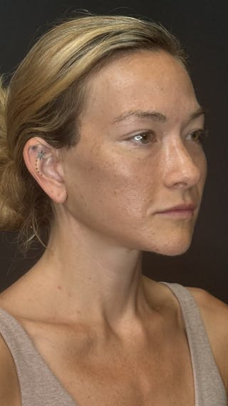 Deep Plane Facelift 40s Before & After Gallery - Patient 289160 - Image 4