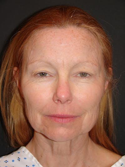 Deep Plane Facelift 60s Before & After Gallery - Patient 201566 - Image 1