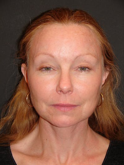 Deep Plane Facelift 60s Before & After Gallery - Patient 201566 - Image 2