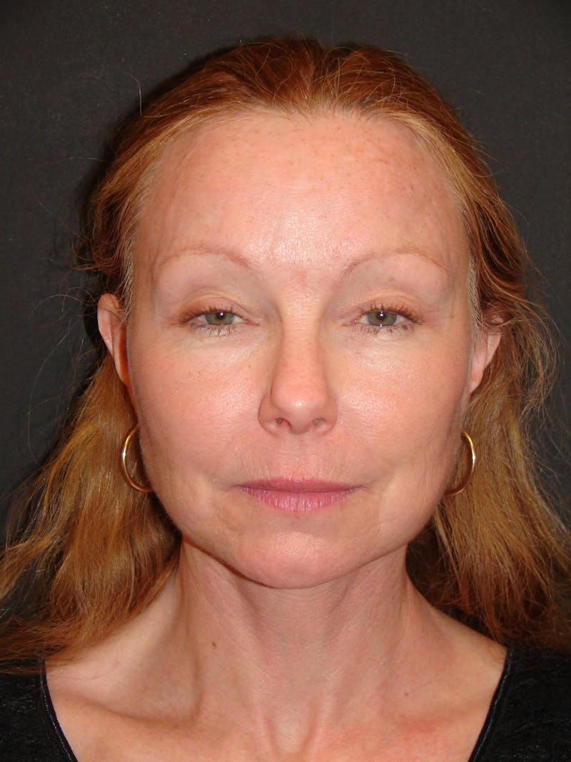 Deep Plane Facelift 60s Before & After Gallery - Patient 201566 - Image 2