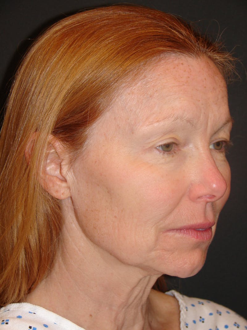 Deep Plane Facelift 60s Before & After Gallery - Patient 201566 - Image 3