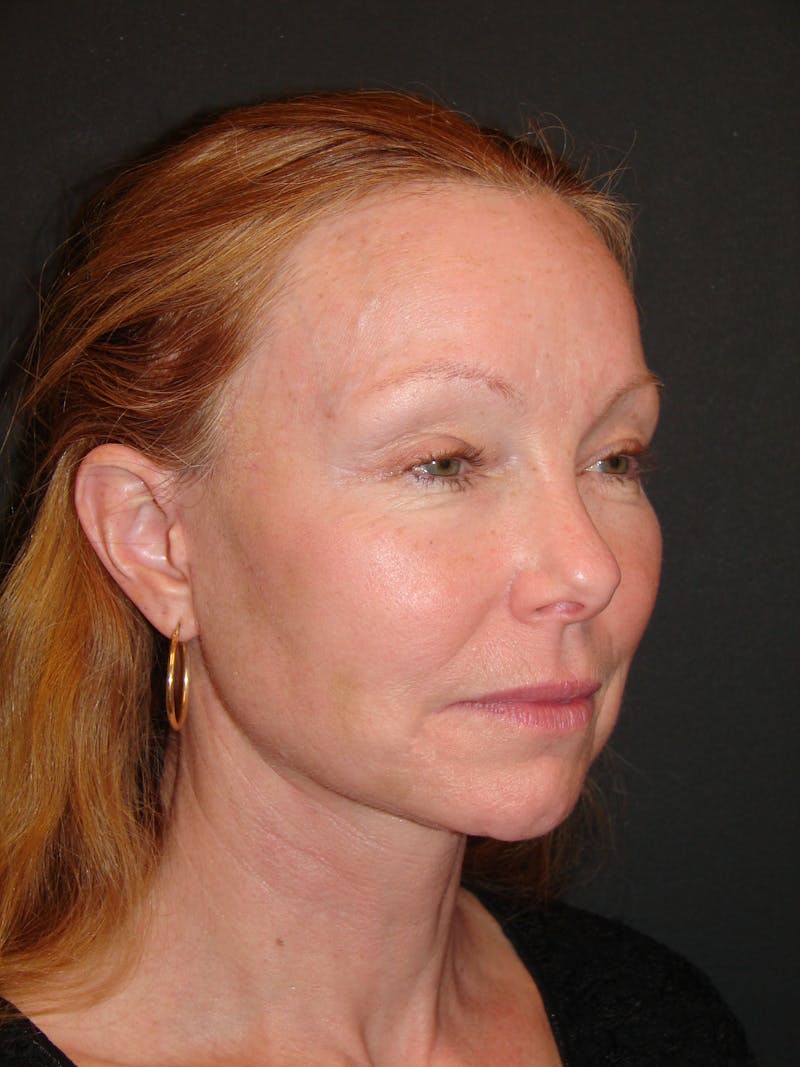 Deep Plane Facelift 60s Before & After Gallery - Patient 201566 - Image 4