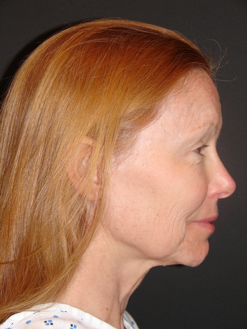 Deep Plane Facelift 60s Before & After Gallery - Patient 201566 - Image 5