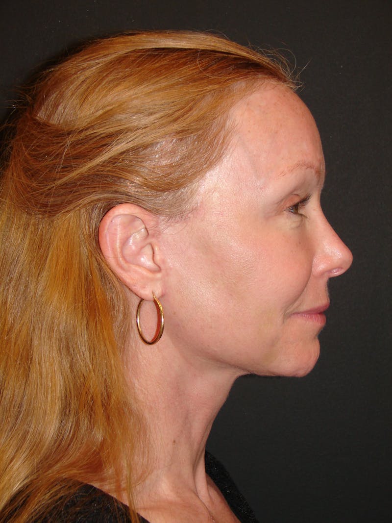Deep Plane Facelift 60s Before & After Gallery - Patient 201566 - Image 6