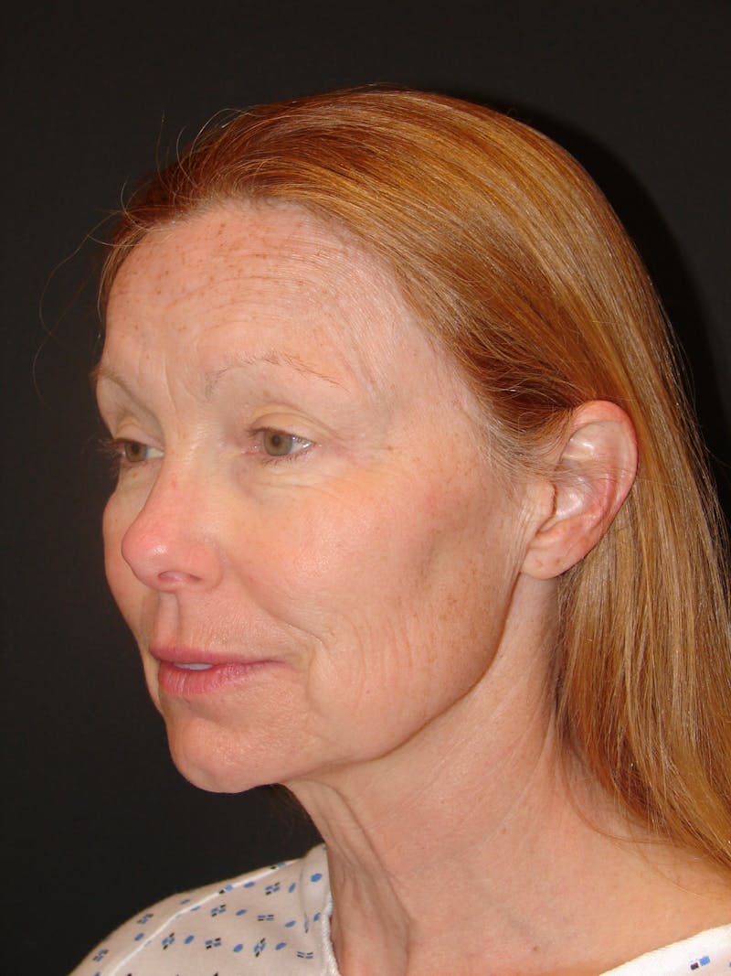 Deep Plane Facelift 60s Before & After Gallery - Patient 201566 - Image 7