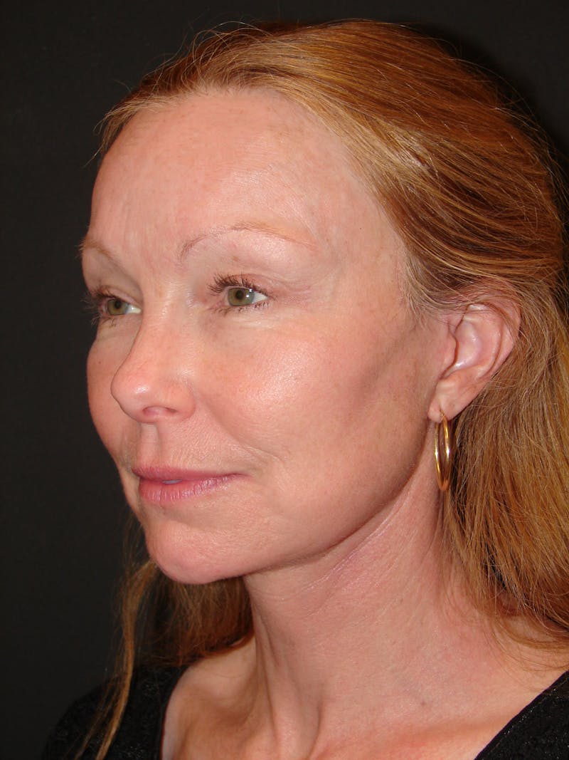 Deep Plane Facelift 60s Before & After Gallery - Patient 201566 - Image 8