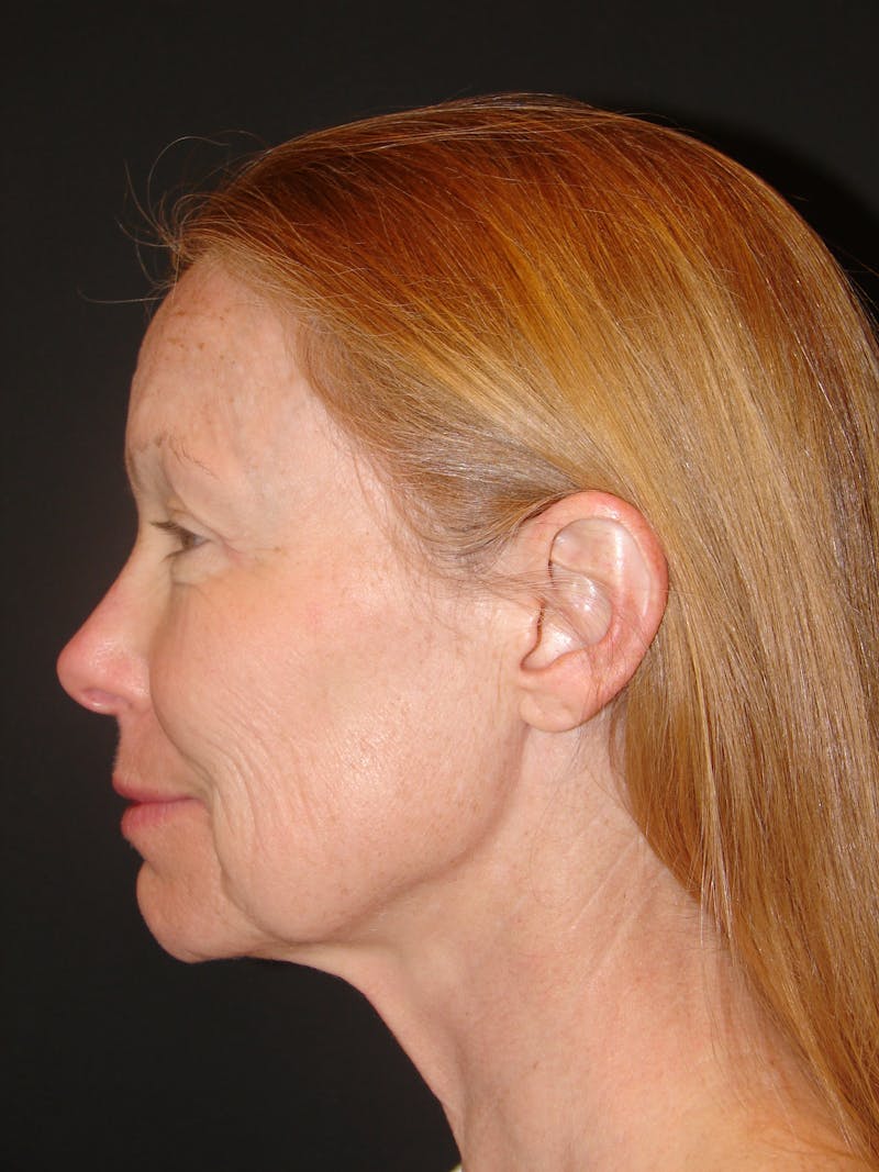 Deep Plane Facelift 60s Before & After Gallery - Patient 201566 - Image 9