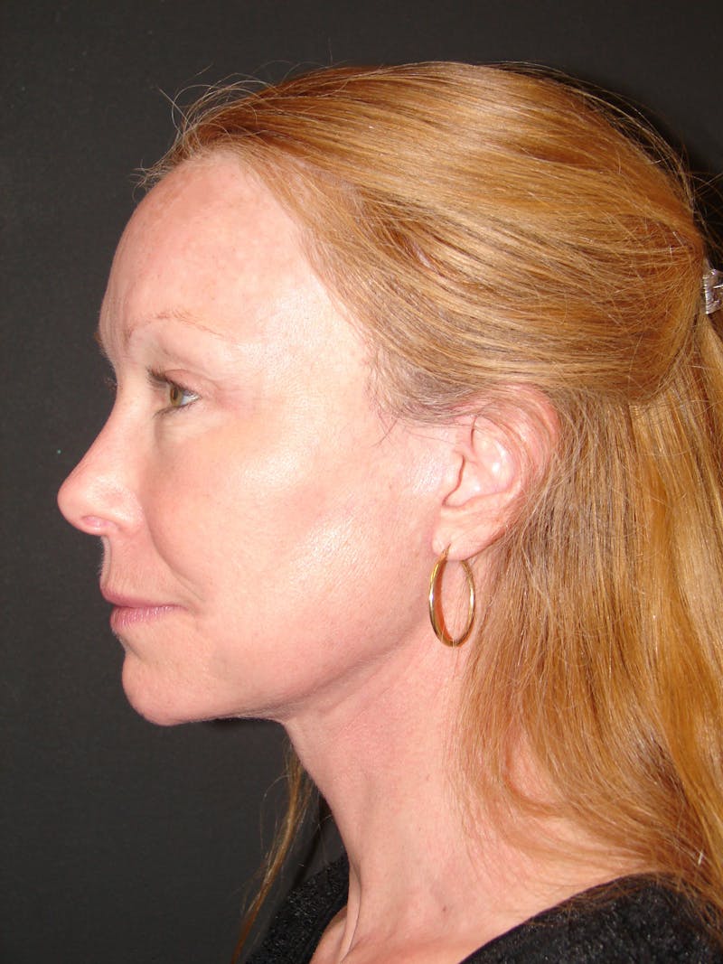 Deep Plane Facelift 60s Before & After Gallery - Patient 201566 - Image 10