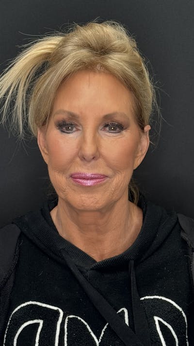 Deep Plane Facelift 60s Before & After Gallery - Patient 387554 - Image 1