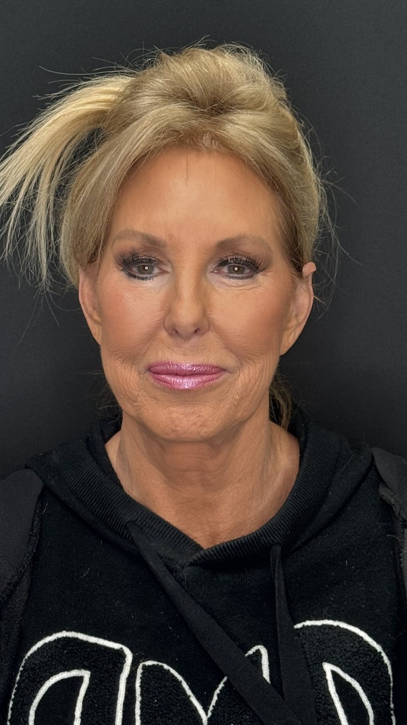 ContourLift Before & After Gallery - Patient 368401 - Image 1