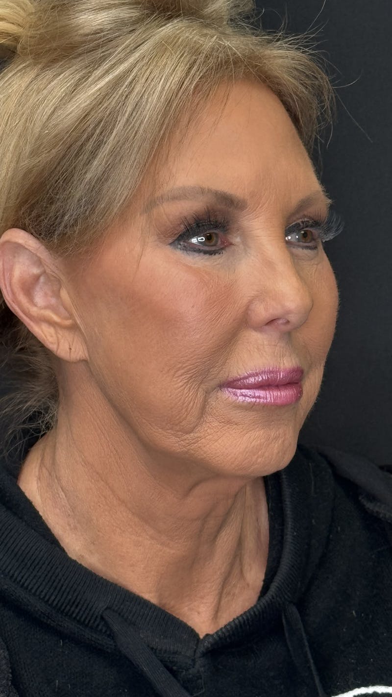 ContourLift Before & After Gallery - Patient 368401 - Image 3