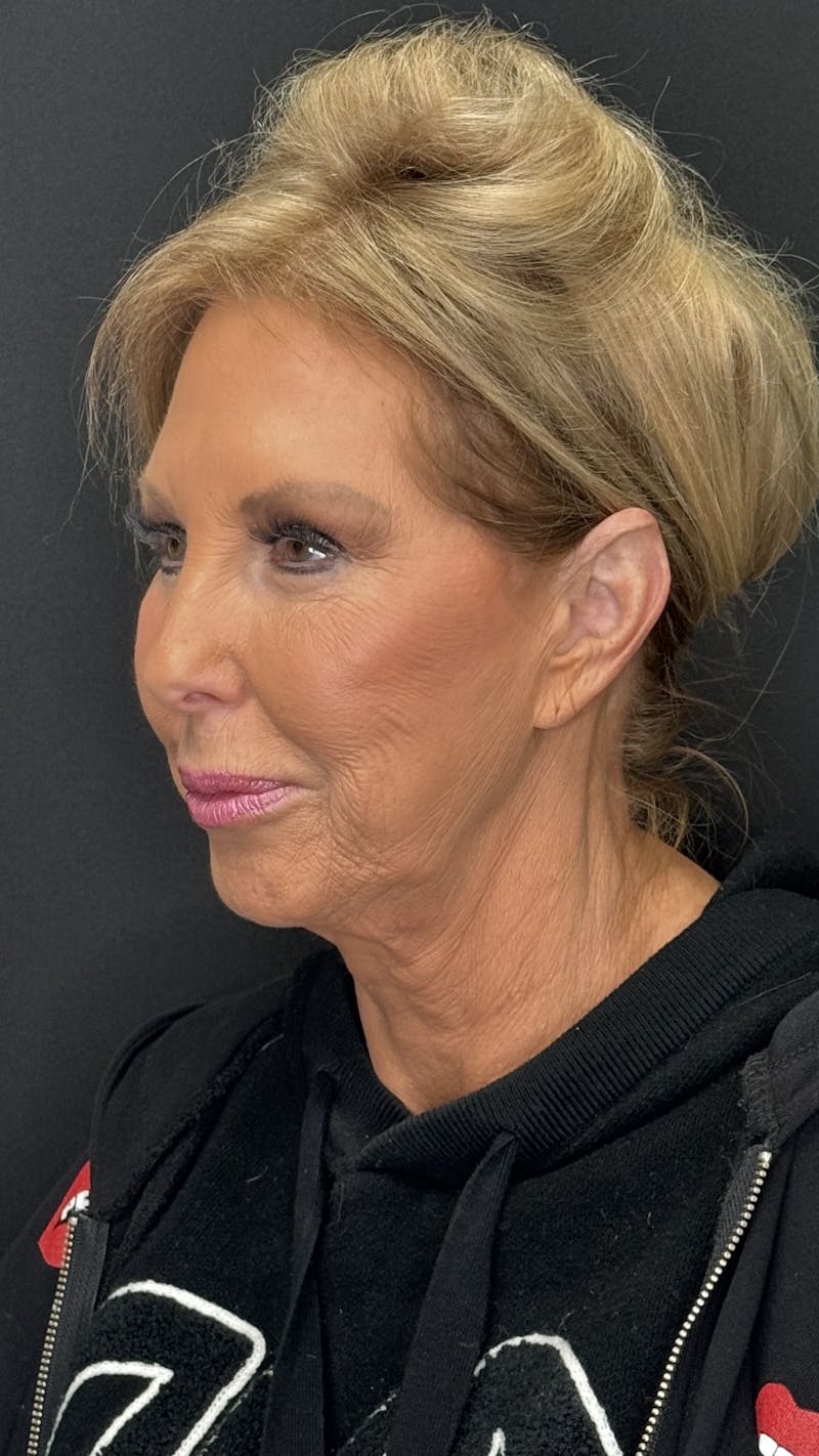 ContourLift Before & After Gallery - Patient 368401 - Image 7