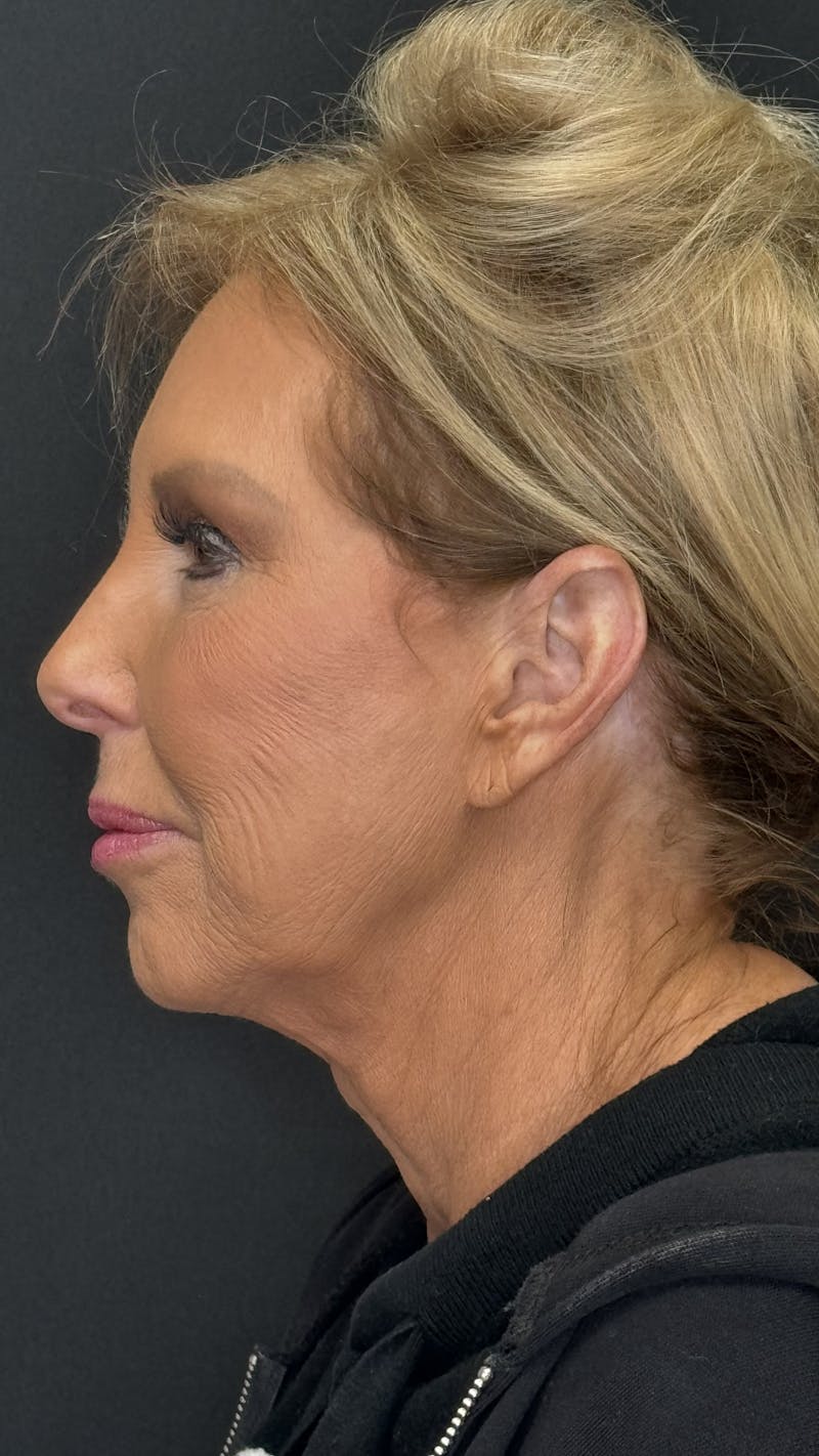 ContourLift Before & After Gallery - Patient 368401 - Image 9