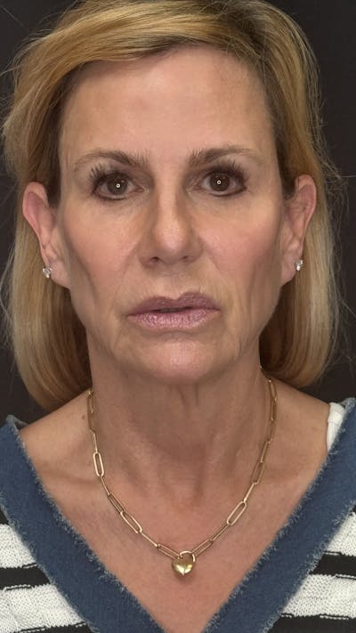 Deep Plane Facelift 60s Before & After Gallery - Patient 300475 - Image 1