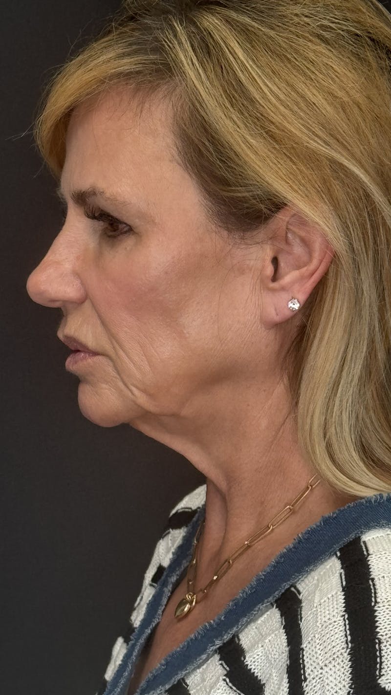 Deep Plane Facelift 60s Before & After Gallery - Patient 300475 - Image 9