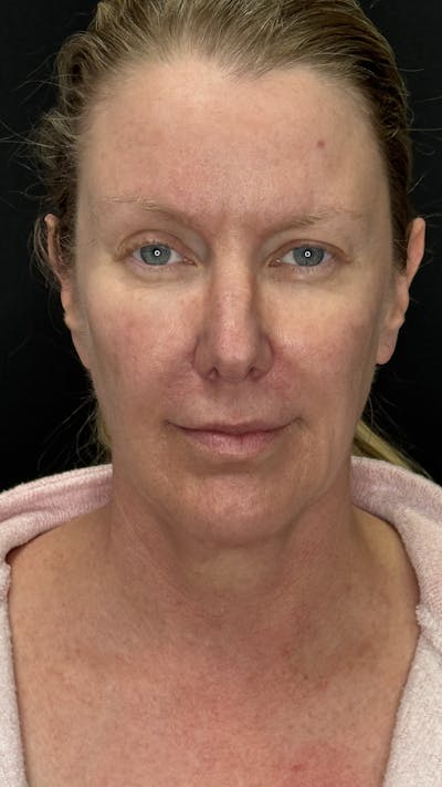 Deep Plane Facelift 50s Before & After Gallery - Patient 333058 - Image 1