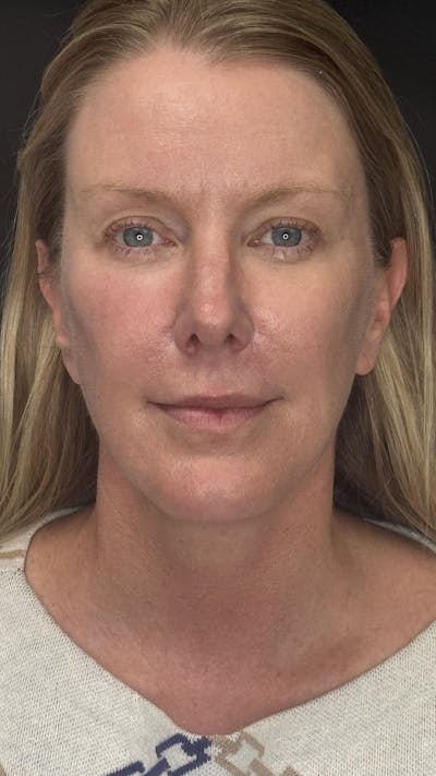 Deep Plane Facelift 50s Before & After Gallery - Patient 333058 - Image 2
