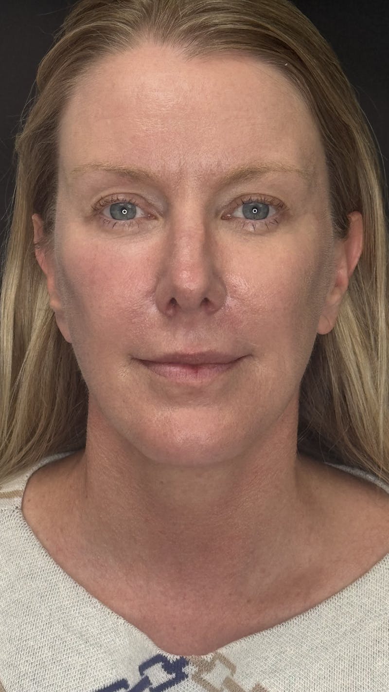 ContourLift Before & After Gallery - Patient 336554 - Image 2