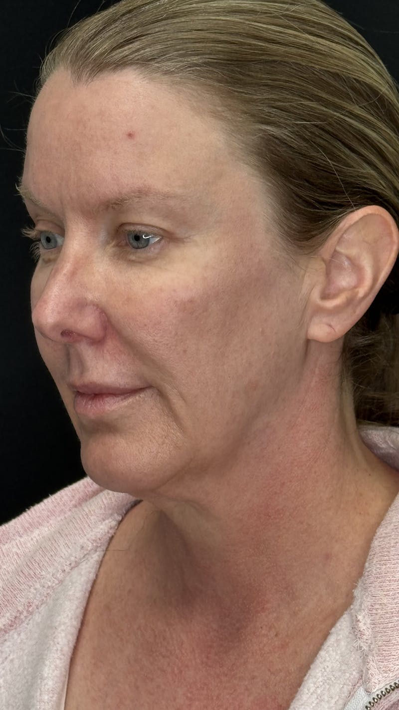 ContourLift Before & After Gallery - Patient 336554 - Image 3