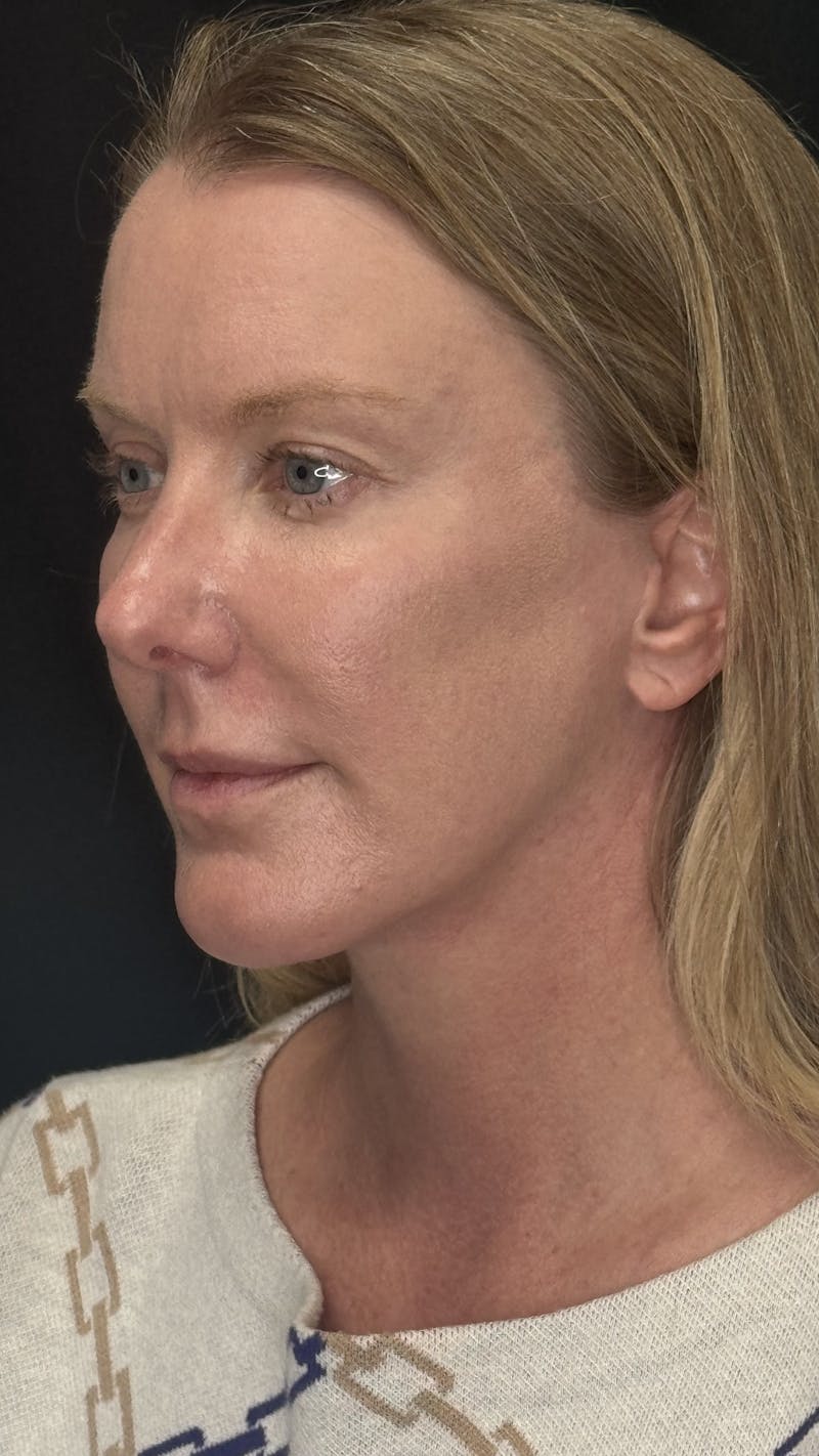 ContourLift Before & After Gallery - Patient 336554 - Image 4