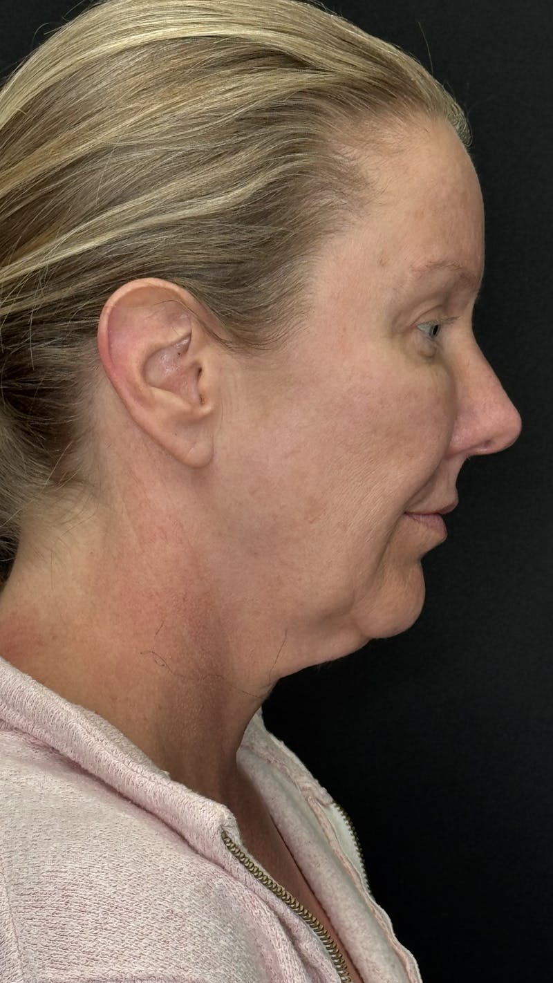 ContourLift Before & After Gallery - Patient 336554 - Image 5