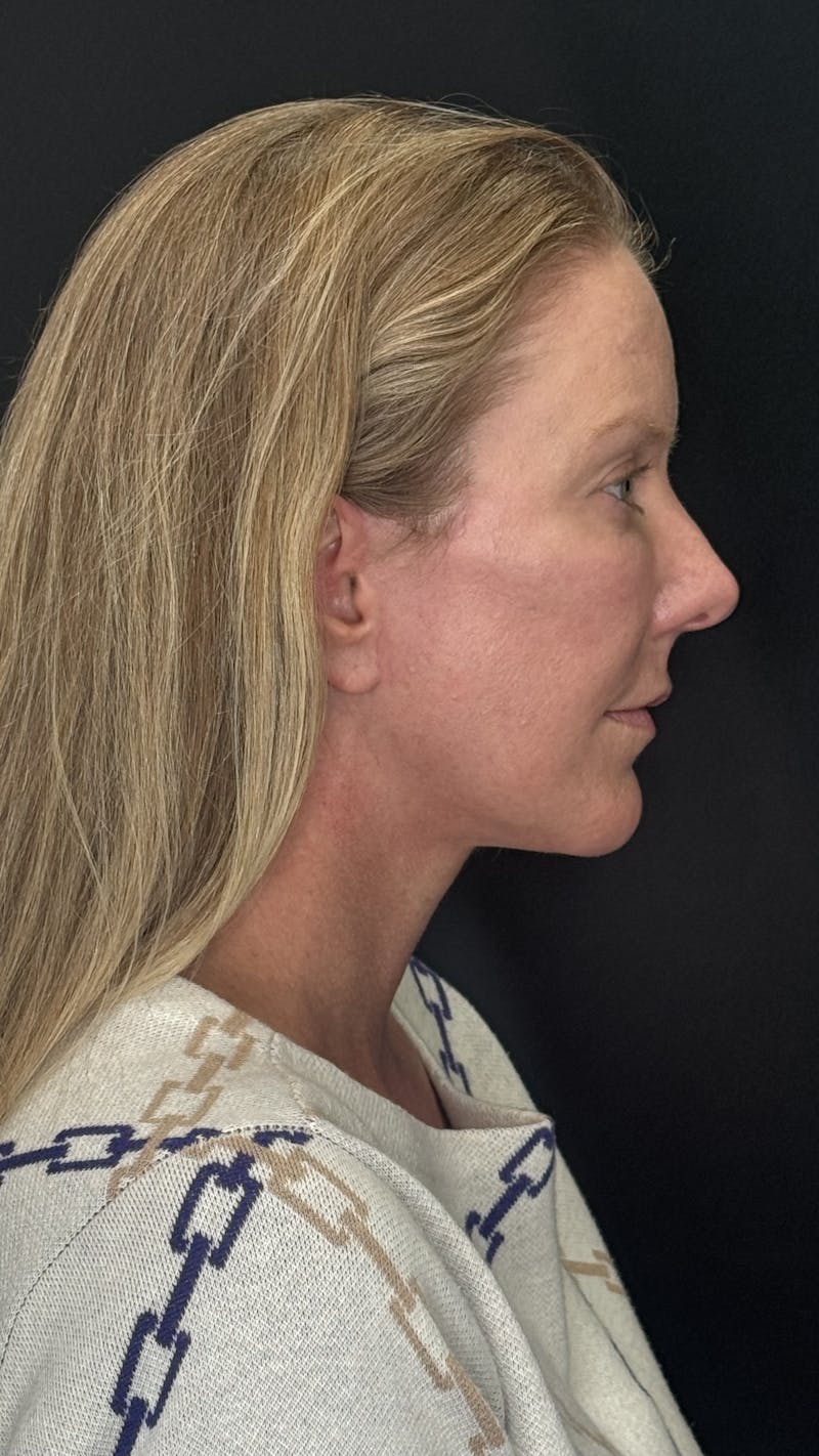 ContourLift Before & After Gallery - Patient 336554 - Image 6