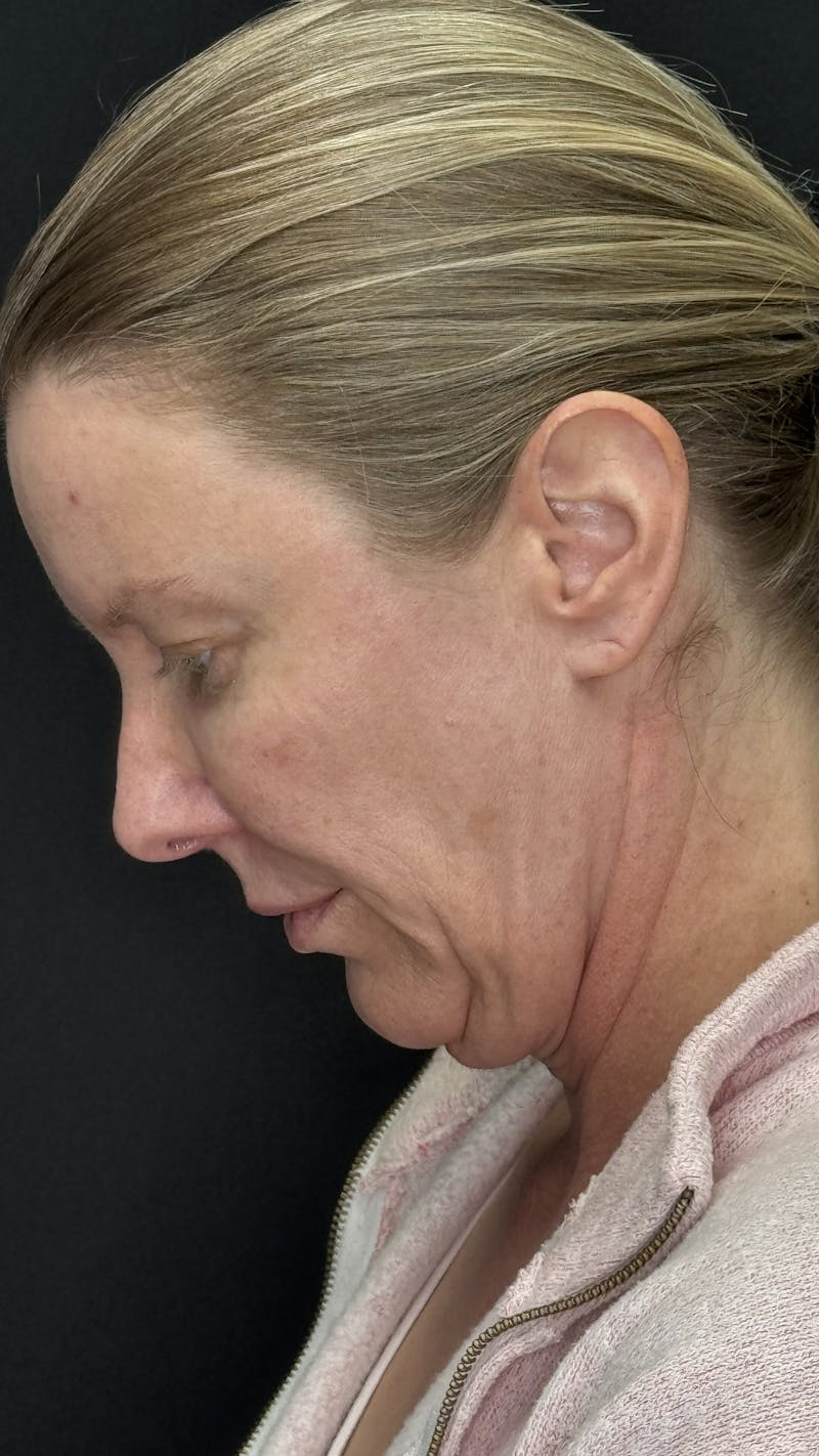 ContourLift Before & After Gallery - Patient 336554 - Image 7