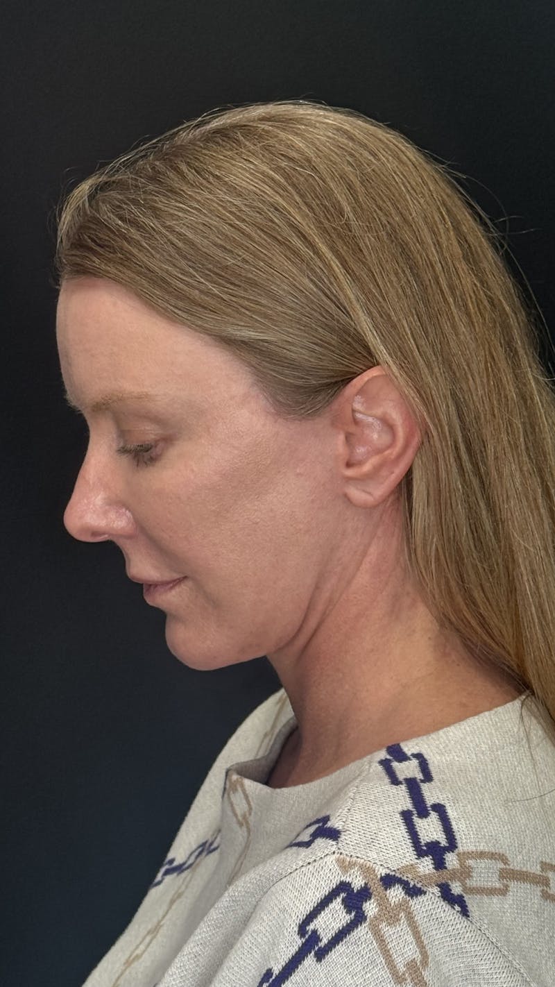 ContourLift Before & After Gallery - Patient 336554 - Image 8