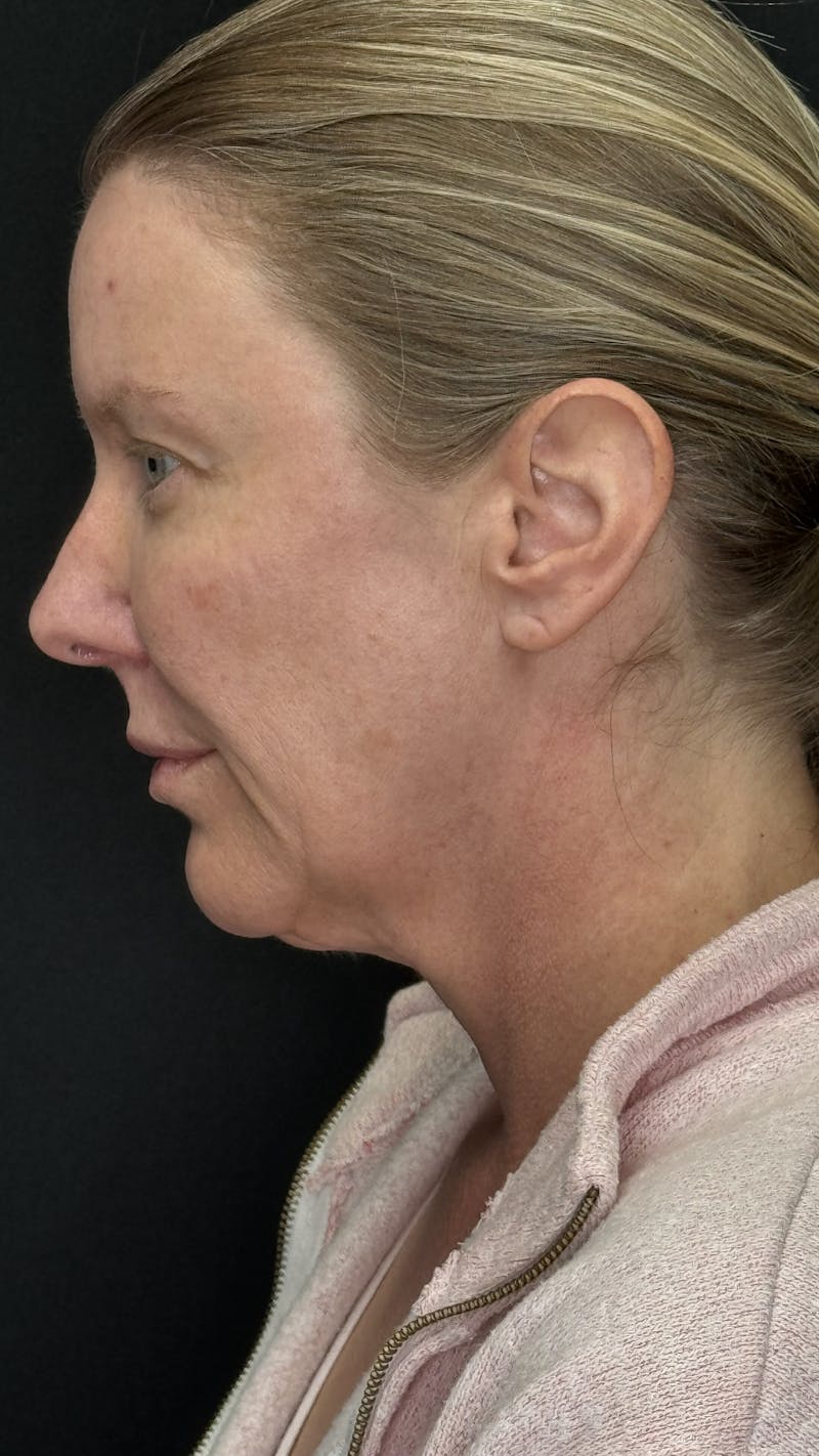 ContourLift Before & After Gallery - Patient 336554 - Image 9