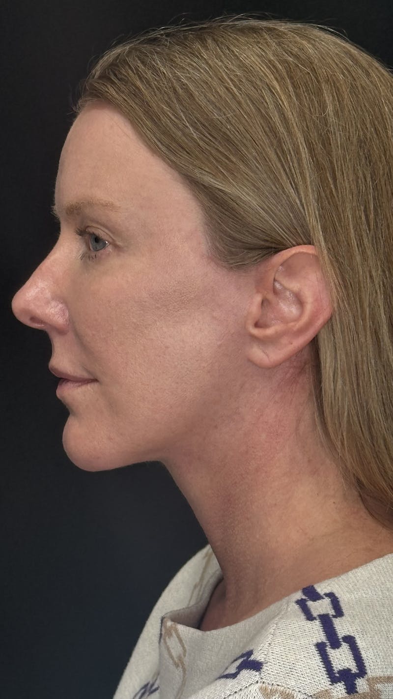 ContourLift Before & After Gallery - Patient 336554 - Image 10