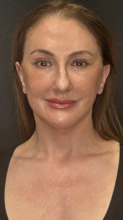 Deep Plane Facelift 40s Before & After Gallery - Patient 103560 - Image 2