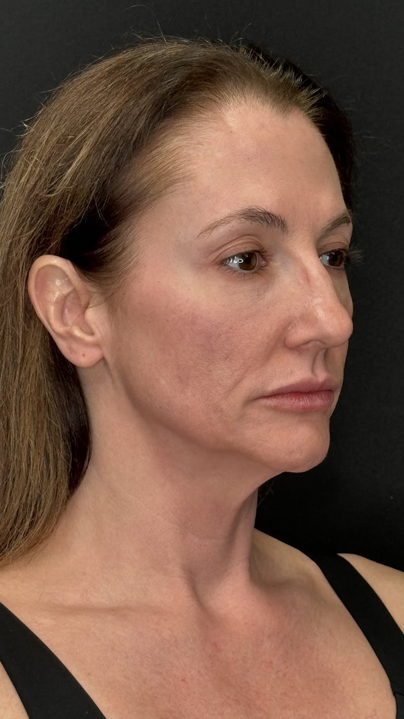 ContourLift Before & After Gallery - Patient 350731 - Image 3