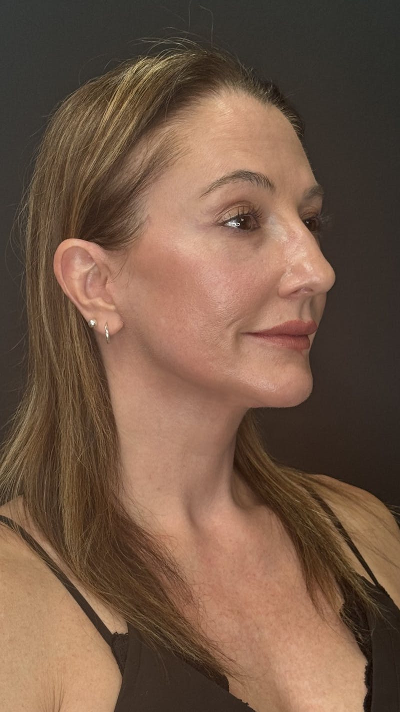 ContourLift Before & After Gallery - Patient 350731 - Image 4