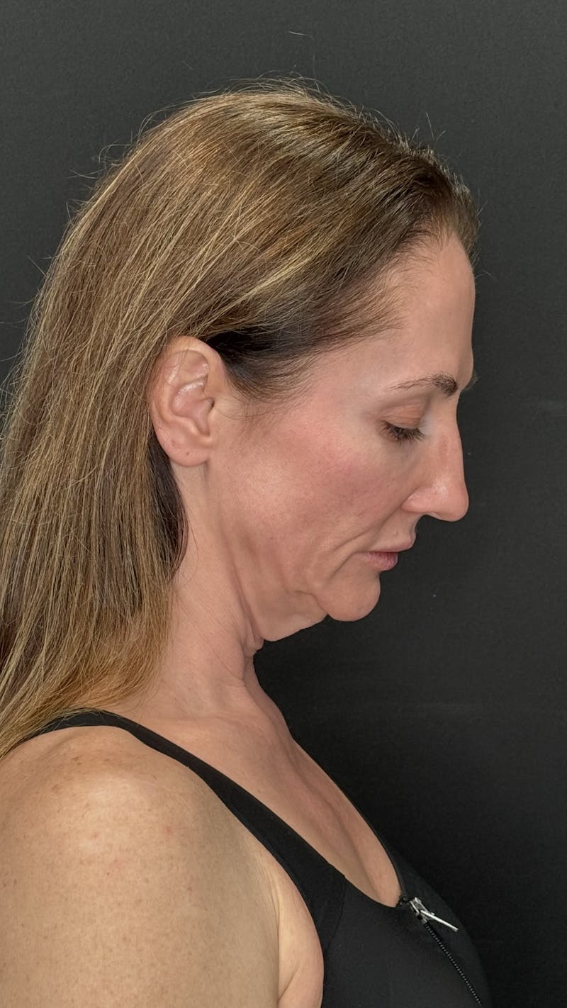 ContourLift Before & After Gallery - Patient 350731 - Image 5