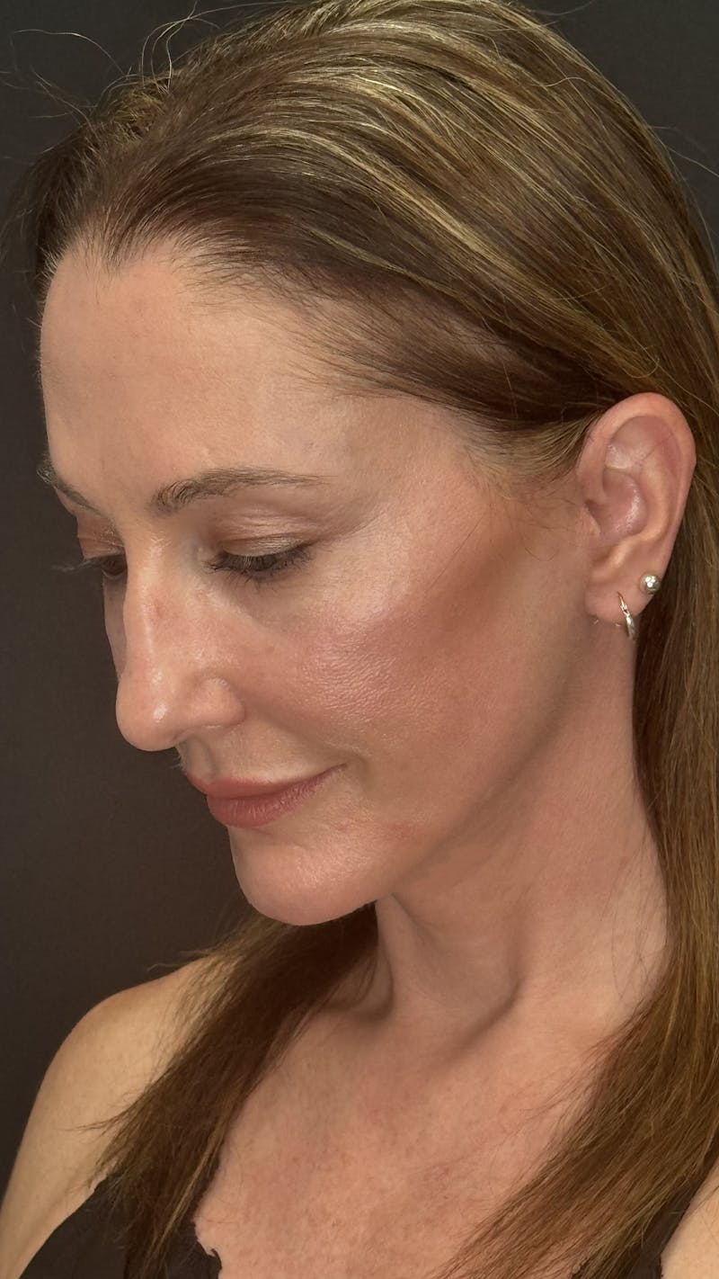 ContourLift Before & After Gallery - Patient 350731 - Image 8