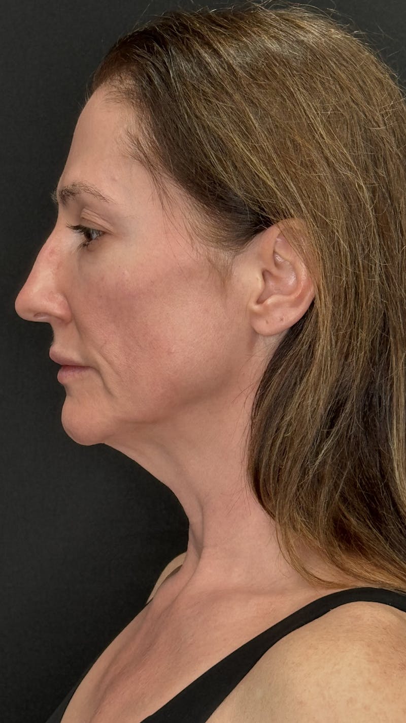 ContourLift Before & After Gallery - Patient 350731 - Image 9
