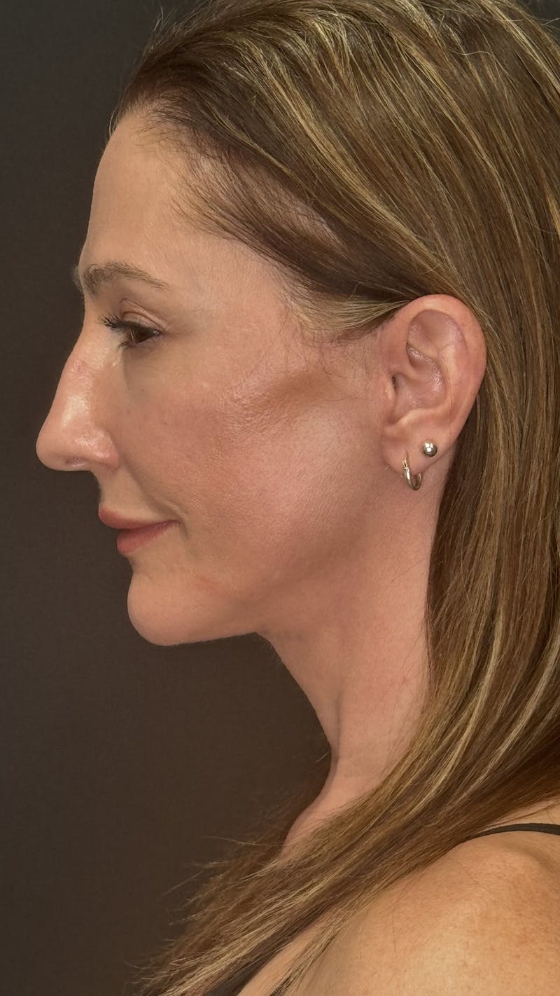 ContourLift Before & After Gallery - Patient 350731 - Image 10